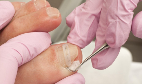 modern ingrown toenail removal